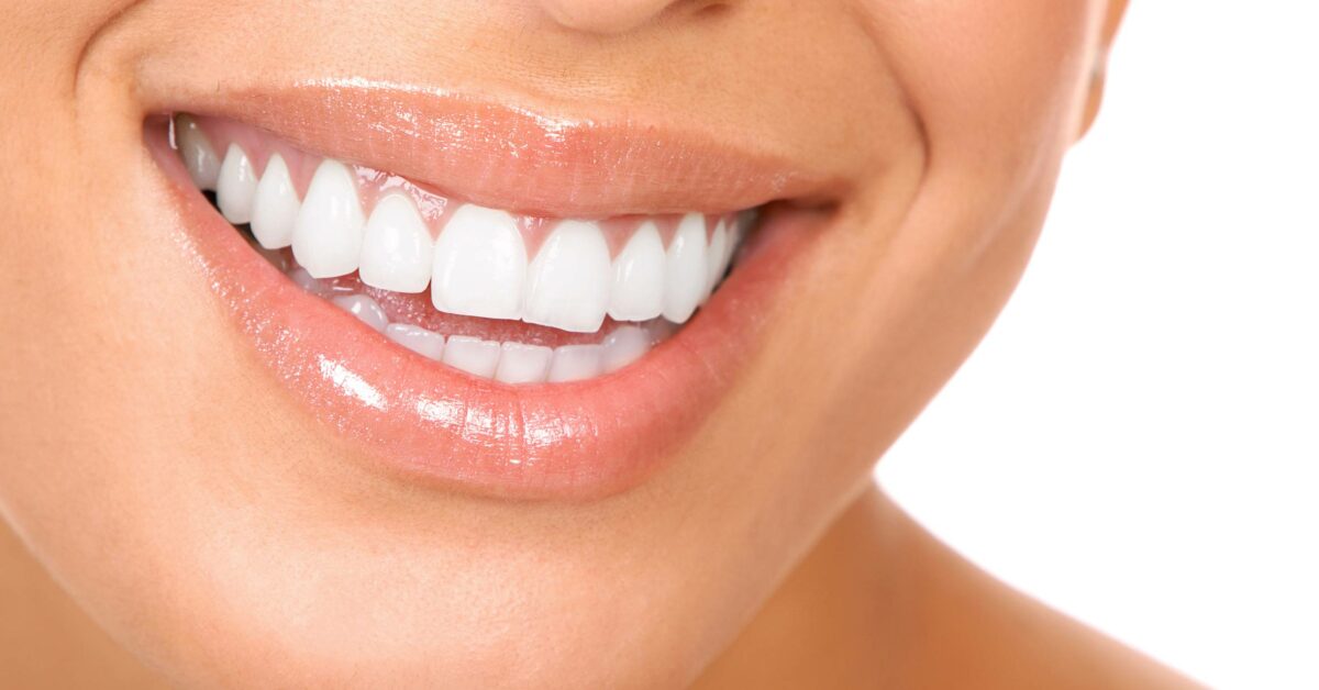 Les jours après… Le détartrage (le calvaire dentaire) ViviB